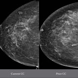 Picture of Breast Tomosynthesis: Comprehensive Breast Imaging Cases