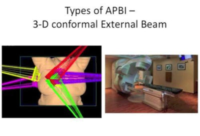 Breast Cancer Radiotherapy: Evolution of Practice