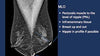 Breast Cancer Screening in the era of Tomosynthesis - Efficiency Learning Systems