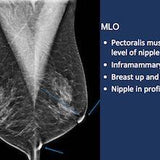 Picture of Breast Cancer Screening in the era of Tomosynthesis