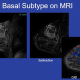 Picture of Breast Cancer Staging and Treatment