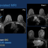 Picture of Breast MRI : Comprehensive 2nd Edition