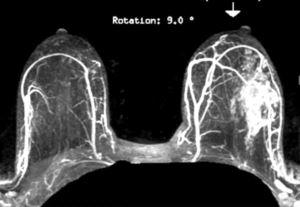 Breast MRI: Comprehensive