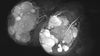 Breast MRI in Benign Breast Disease - Efficiency Learning Systems