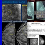 Picture of Breast Tomosynthesis: Initial Modality Training for MQSA