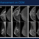 Picture of Contrast Enhanced Mammography: Techniques and Indication
