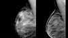 Digital Breast Tomosynthesis: A Better Mammogram - Efficiency Learning Systems