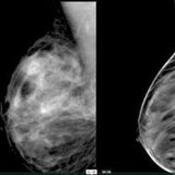 Picture of Digital Breast Tomosynthesis: A Better Mammogram