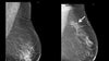 High Risk Surveillance – Mammographic and MRI Surveillance after Breast Cancer - Efficiency Learning Systems