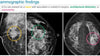 Invasive Lobular Carcinoma Multimodality Primer - Efficiency Learning Systems