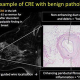 Picture of Spectrum of Clustered Ring Enhancement (CRE) on Breast MRI: Malignancies and their Mimics