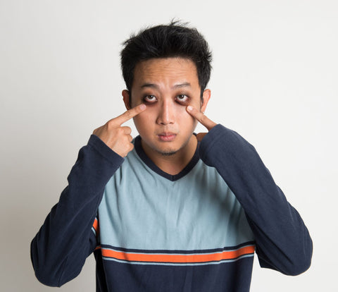 Causes of dark circled eyes, man with dark circles under his eyes and pointing at those