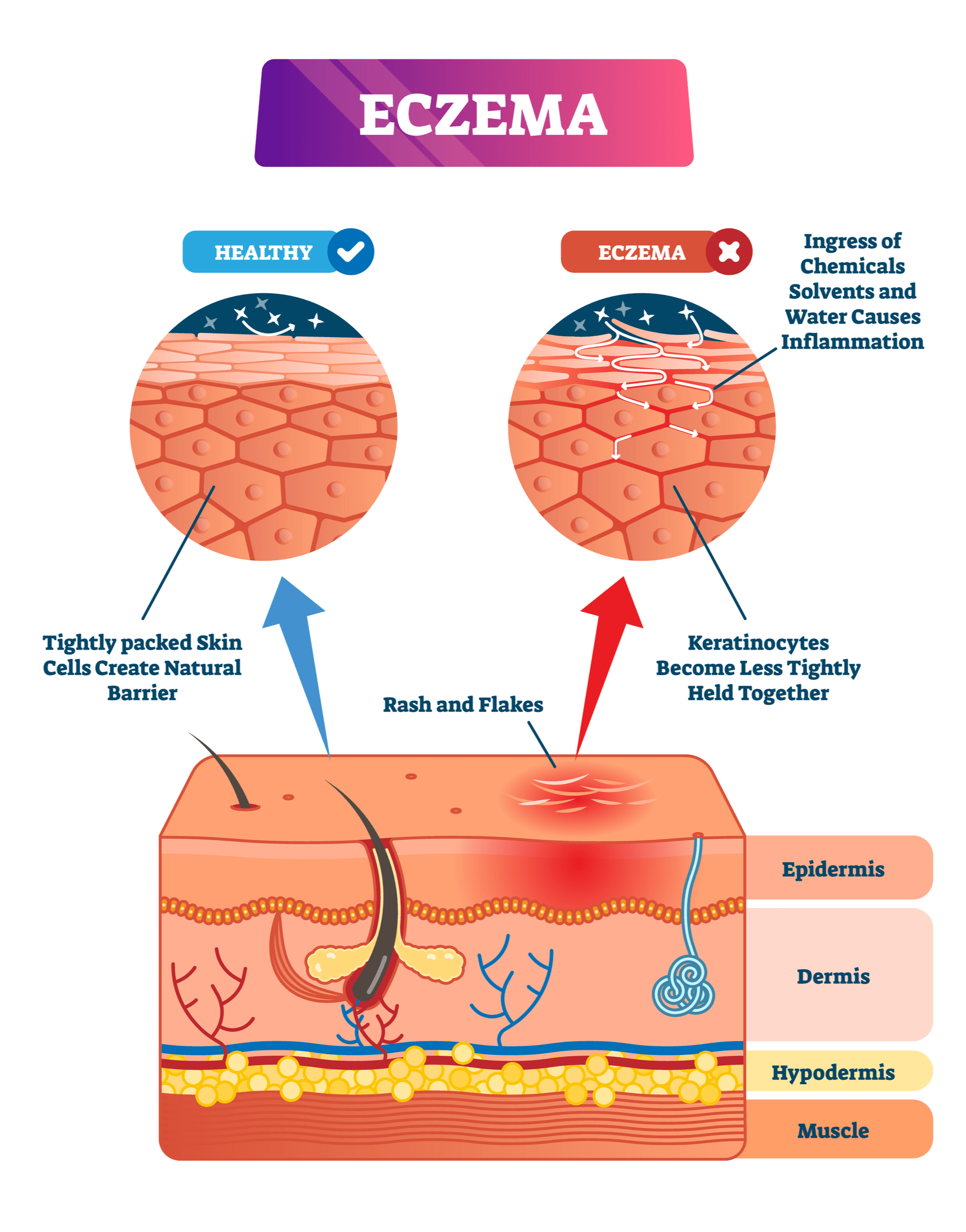 Definition of Eczema 