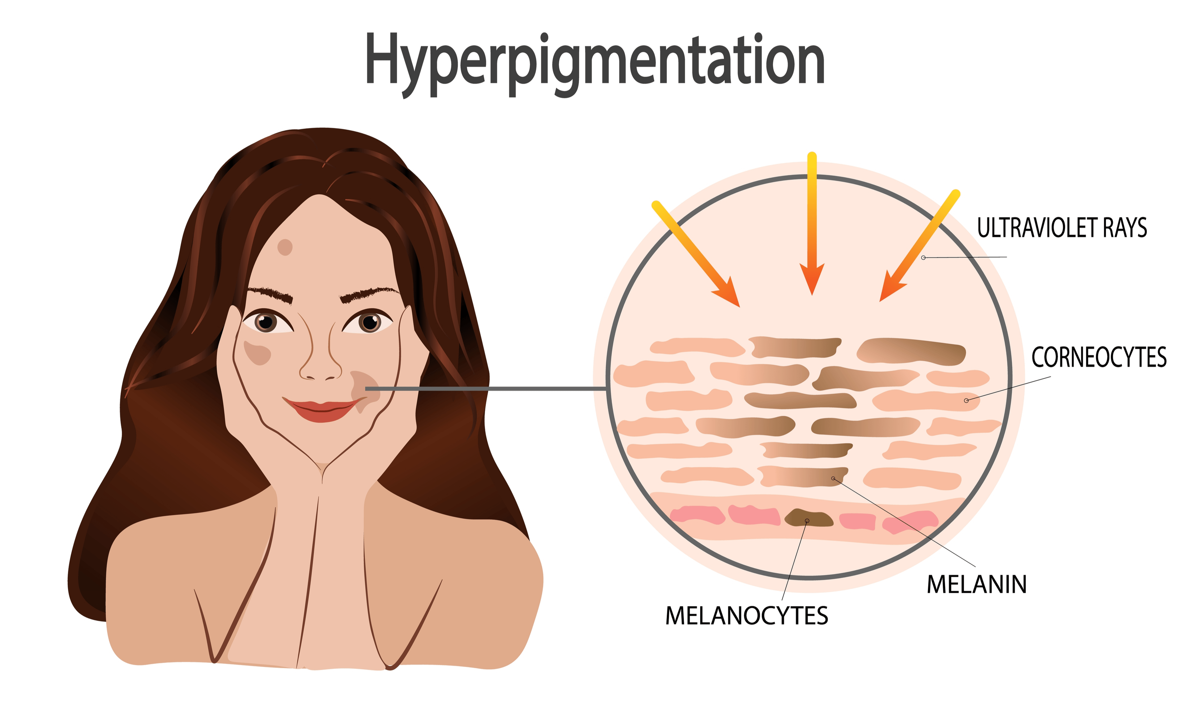 cause of dark spots (hyperpigmentation)
