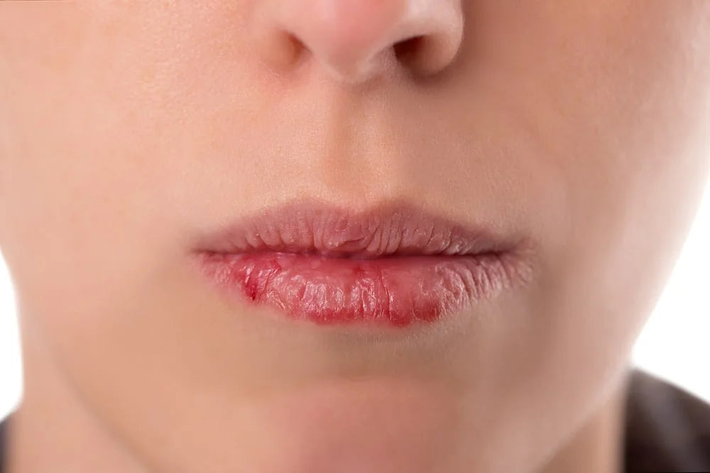 Cracked Lips and Cold Sores (HPV)