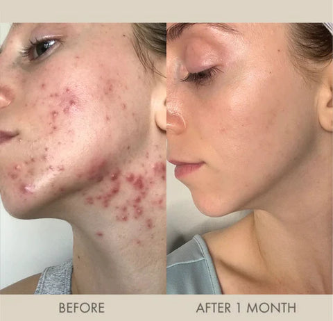 high frequency wand before and after