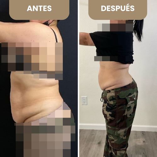 Antes y Despues Lipo 207