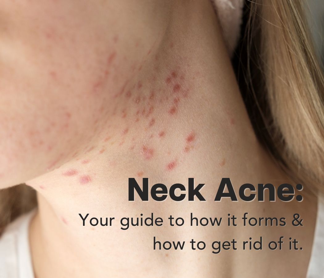 Neck Pimples! Unblocking those pesky, unwanted breakouts. | Cactus Skincare