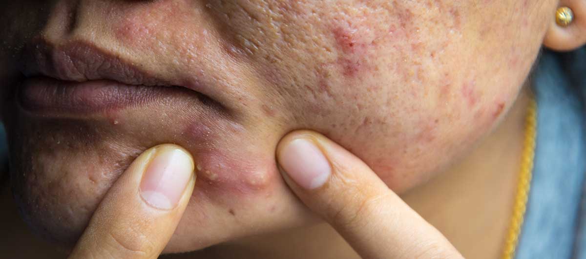 what causes under skin pimples