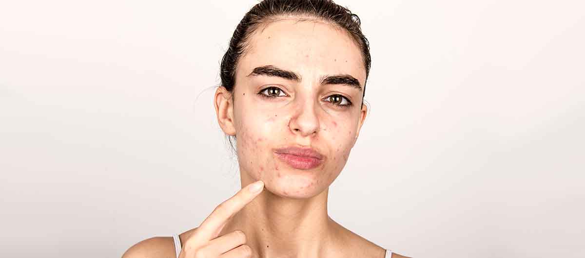 Top 7 Home Remedies for Acne Prone Skin – Re'equil