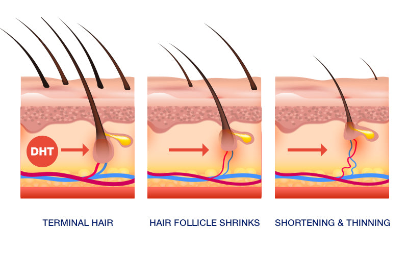 What Is The Role Of DHT In Hair Loss  Reequil