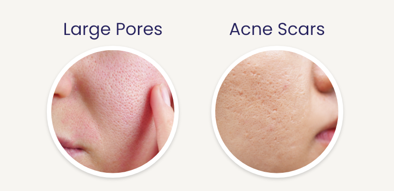 Difference between large pores and acne scars_desktop_reequil