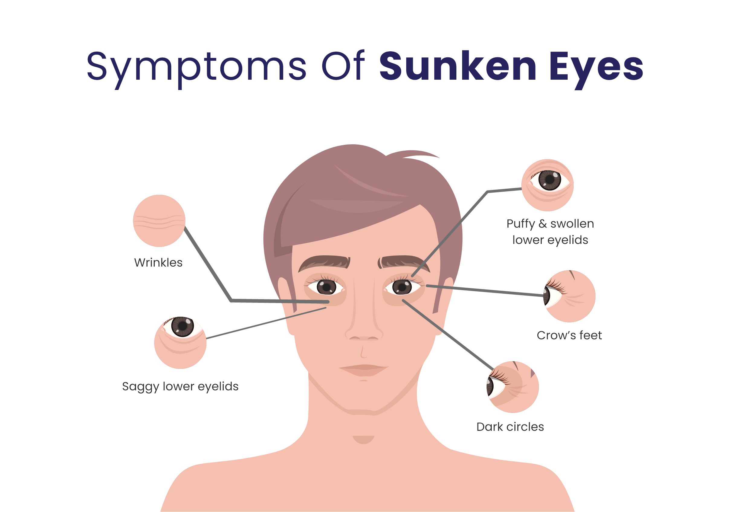 Undereye problems like dark circles and sunken eyes can be treated with  these medical treatments  Health Tips and News