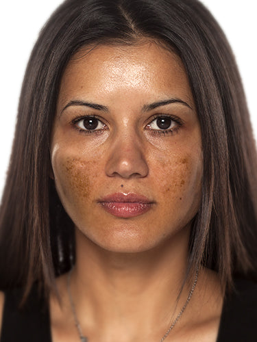 Post-Inflammatory Hyperpigmentation (PIH) on the Skin