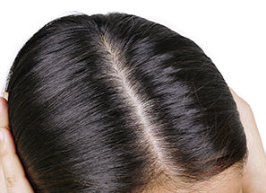 severe greasy dandruff treatment lotion