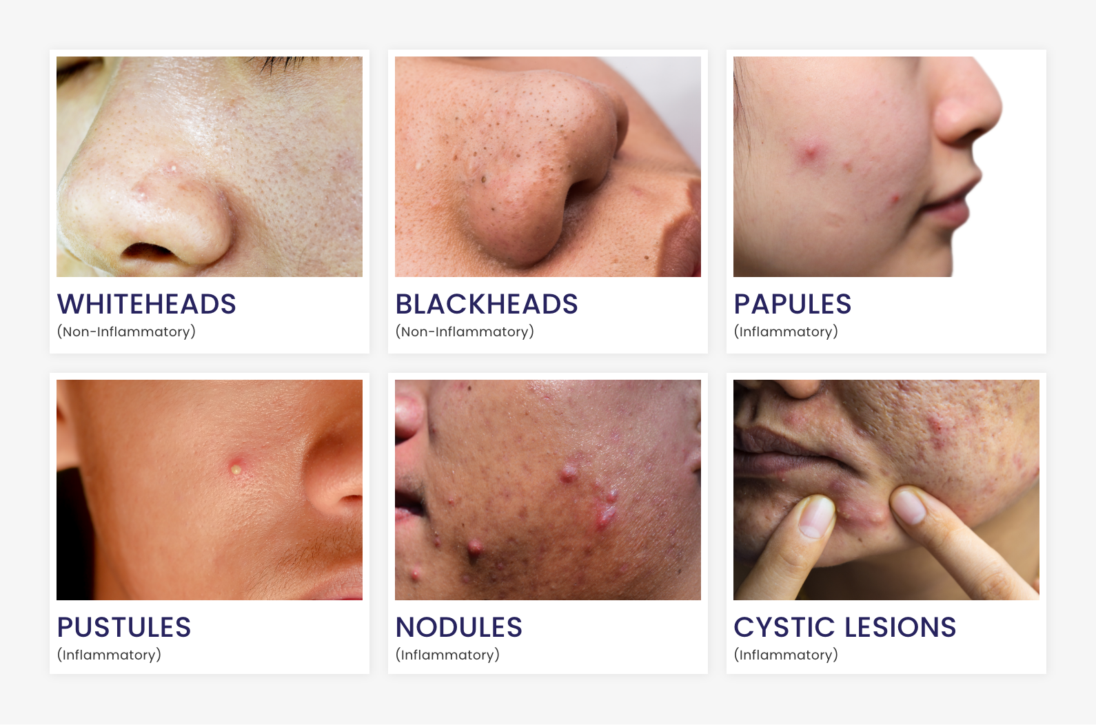 Know Your Acne Type & Causes. Dermat Explains Skincare Routine Tailored To Your Acne-prone Skin