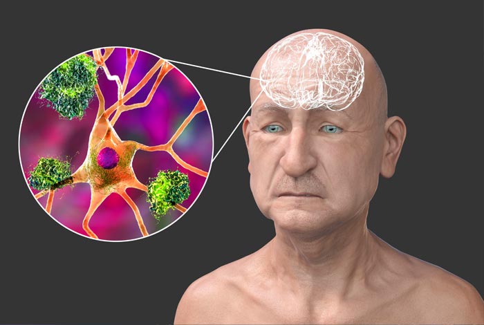 Dementia illustration