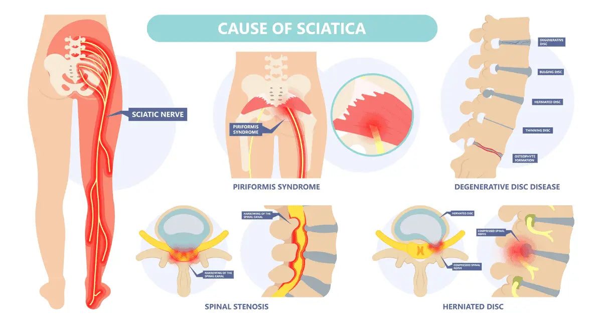 Diagram showing causes of sciatica