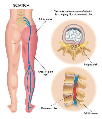 Diagram showing sciatica