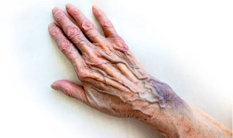 Bruised elderly hand