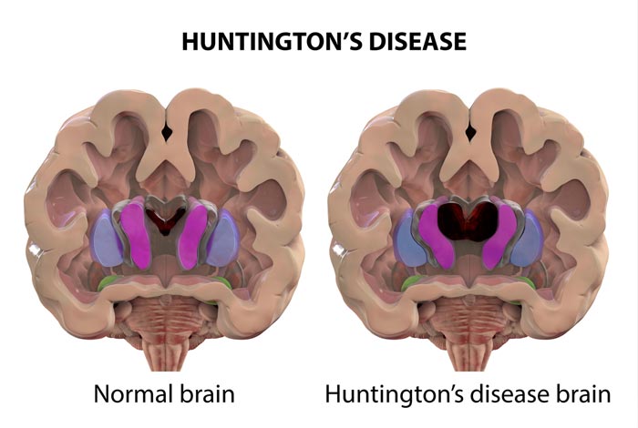 Huntington's Disease