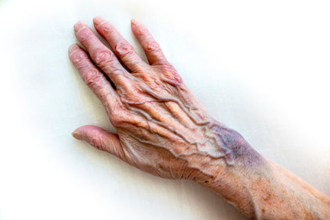 Bruised hand of an elderly