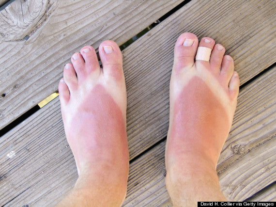 feet with thong sunburn
