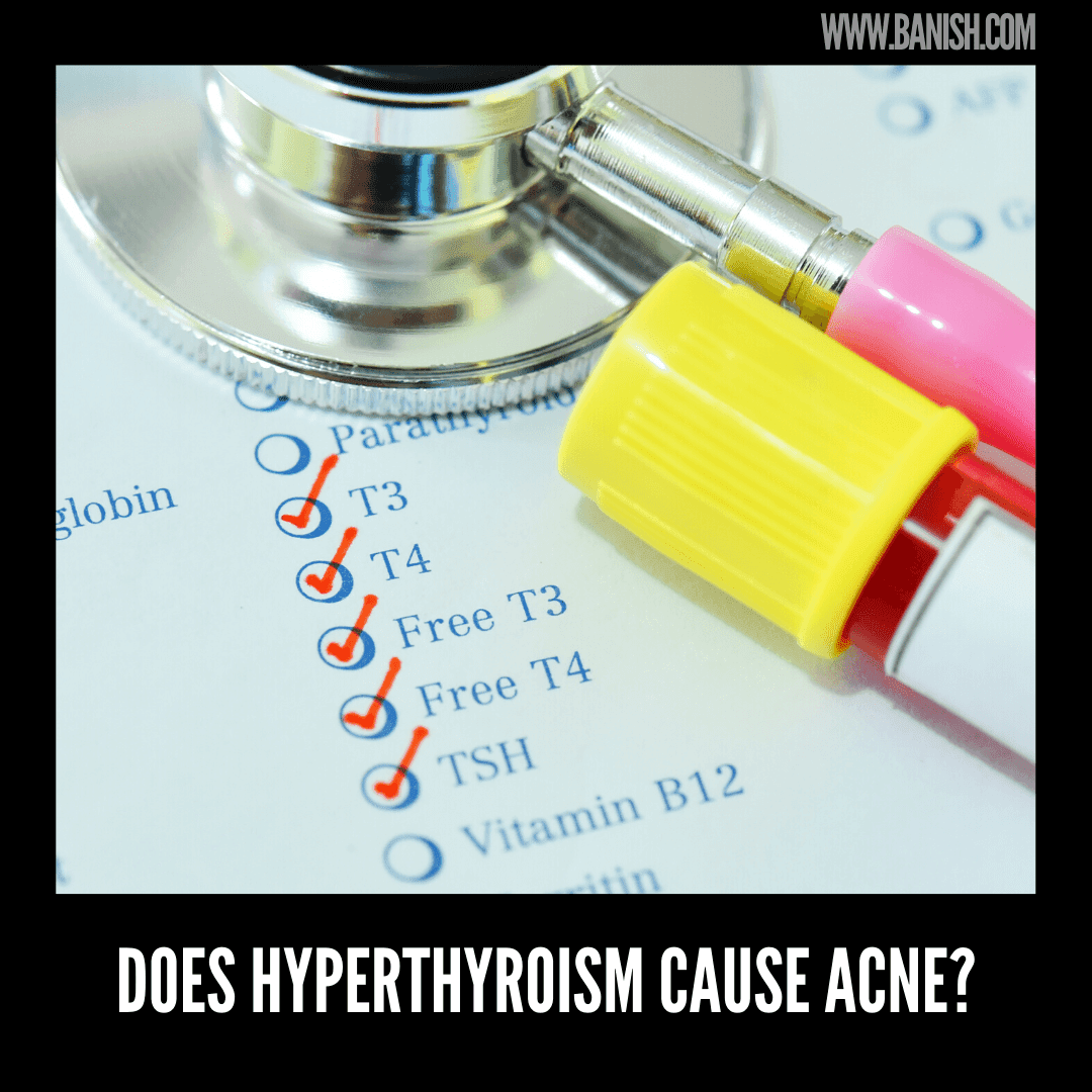 VOORZIET HYPERTHYROIDISME IN ACNE