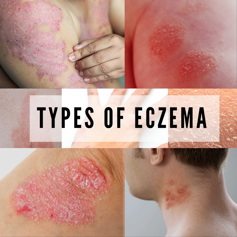 7 Types Of Eczema And Its Symptoms Banish