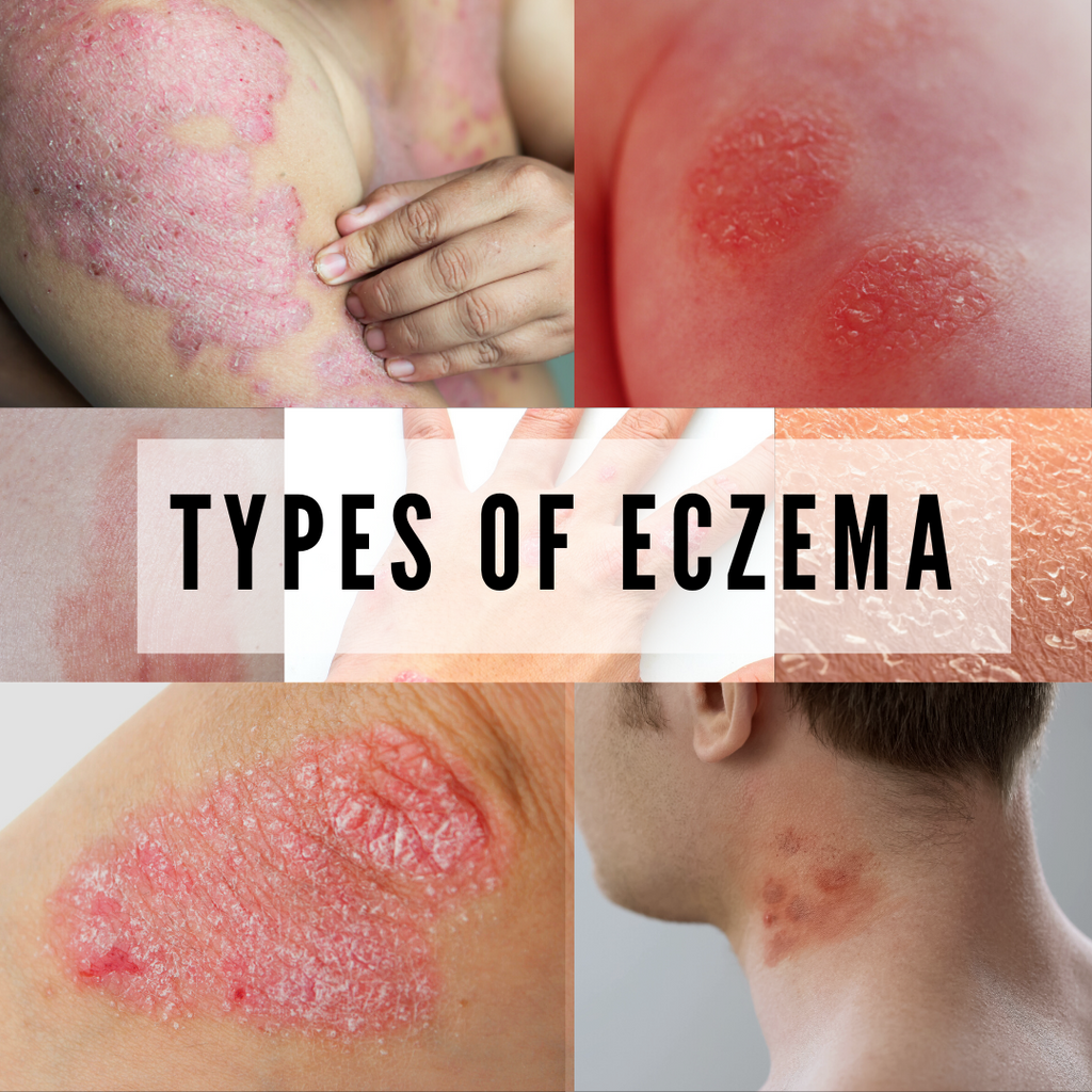 7 Types Of Eczema And Its Symptoms