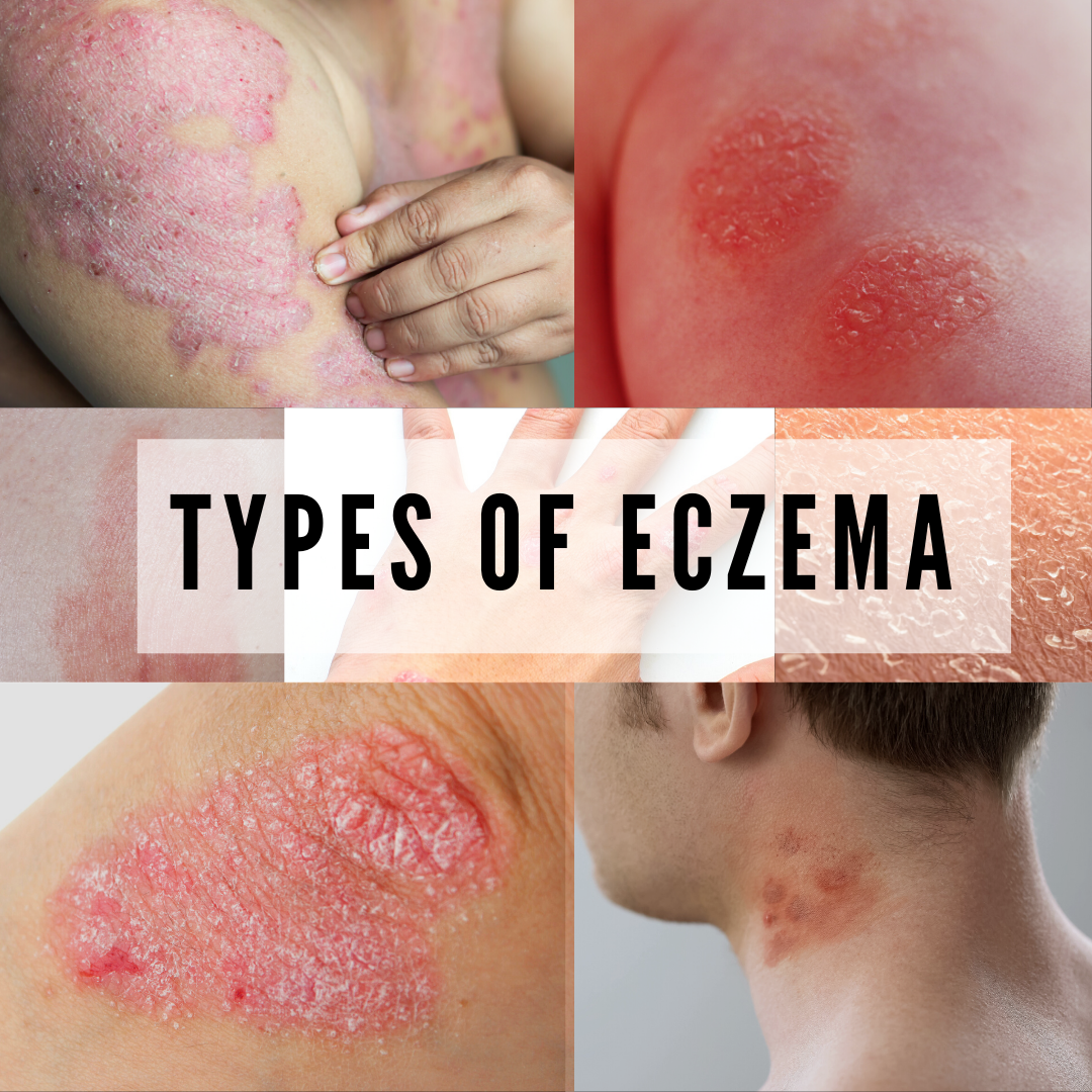 7 Types Of Eczema 6466