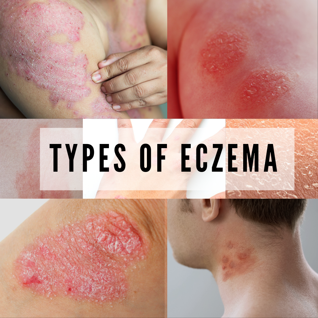 7 TYPES OF ECZEMA AND ITS SYMPTOMS  BANISH