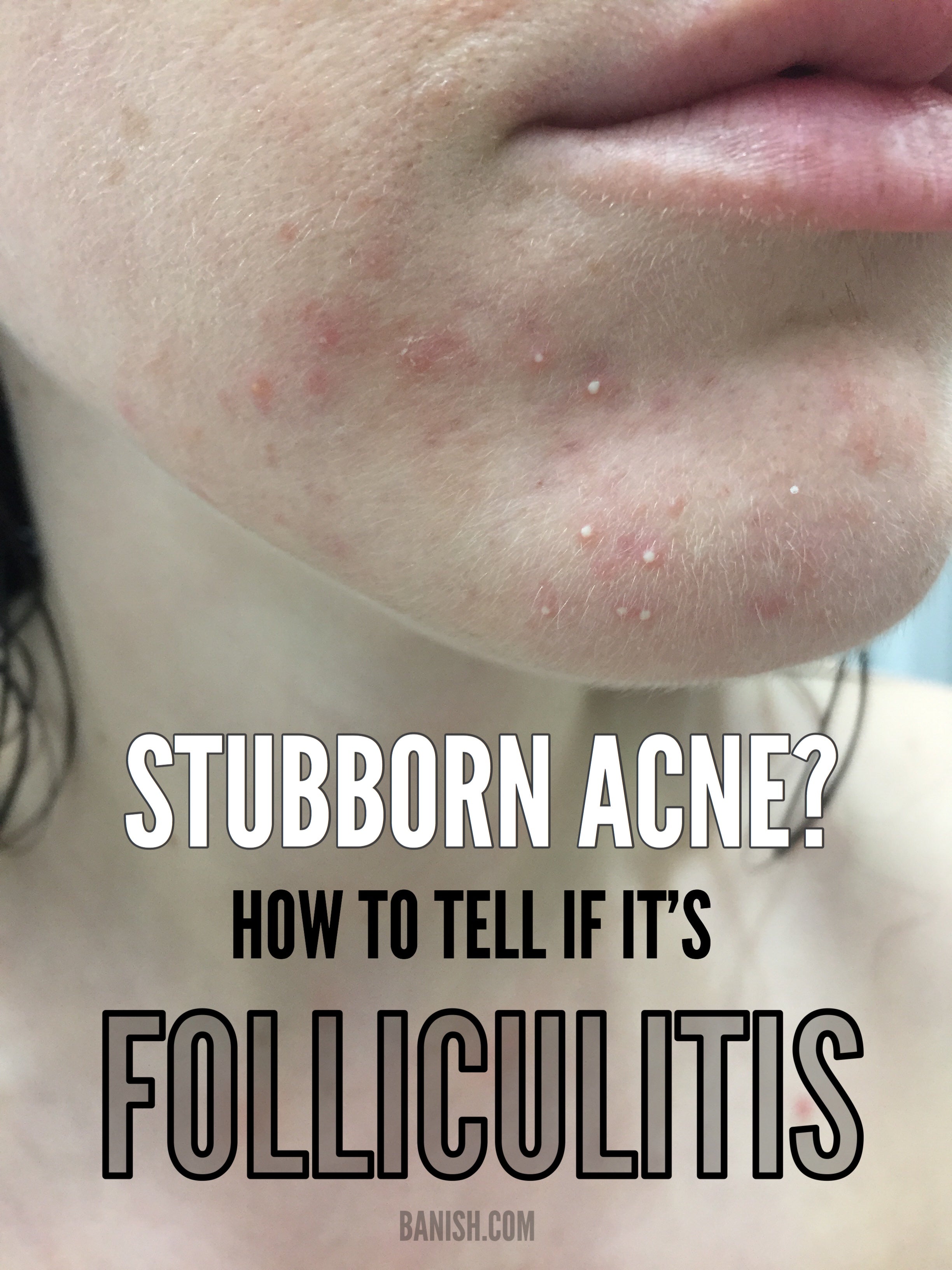 How To Tell If Your Acne Is Actually Folliculitis Banish
