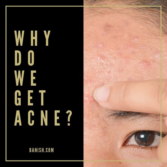 Why Do We Get Acne In The First Place