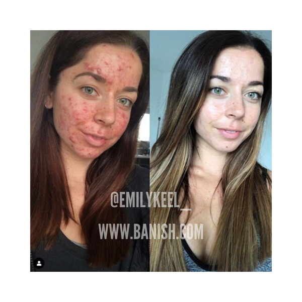 confidence with acne scars