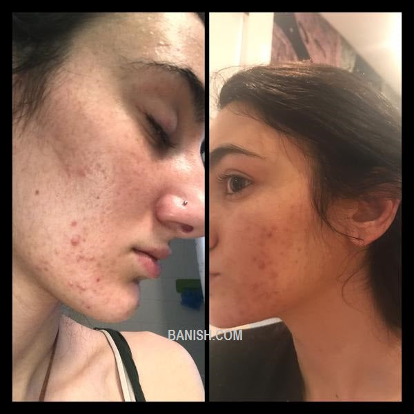 woman with acne, sharing her before and after results