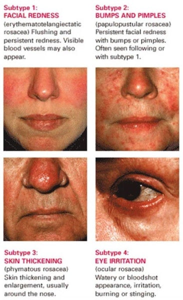 types of rosacea