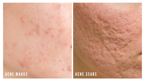 Acne scars compared to post inflammatory hyperpigmentation