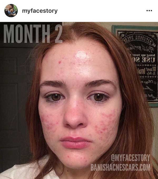 accutane before during and after