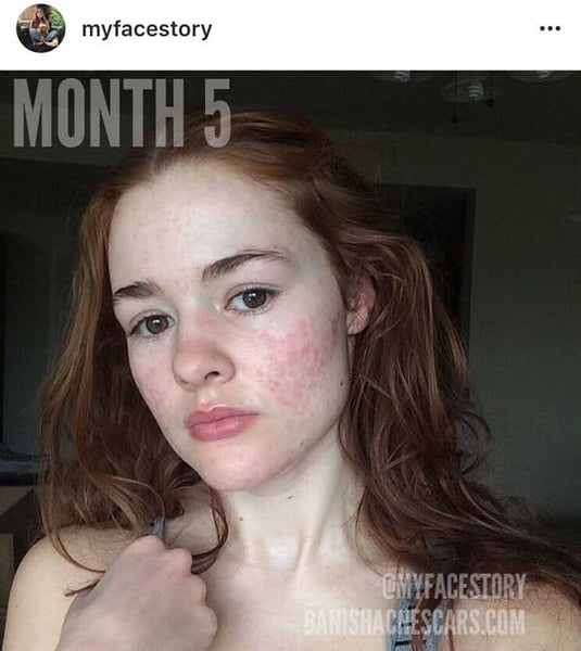 accutane month 5